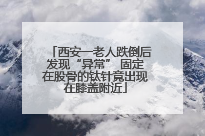西安一老人跌倒后发现“异常” 固定在股骨的钛针竟出现在膝盖附近
